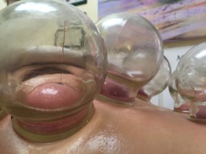 Cupping and acupuncture needles
