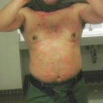 Border Agent with Chemical Burns